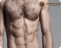 Cấy lông cơ thể