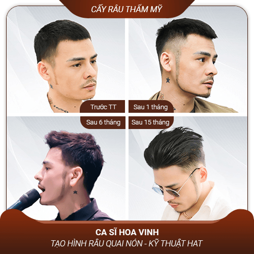 Cấy râu