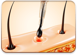 cấy ghép tóc y học quốc tế