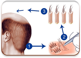 cấy ghép tóc y học quốc tế