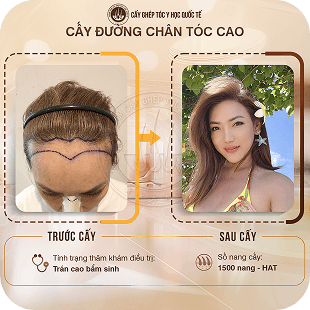 cấy ghép tóc y học quốc tế