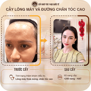 cấy ghép tóc y học quốc tế