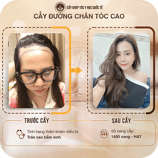 cấy ghép tóc y học quốc tế