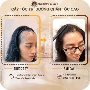 cấy ghép tóc y học quốc tế
